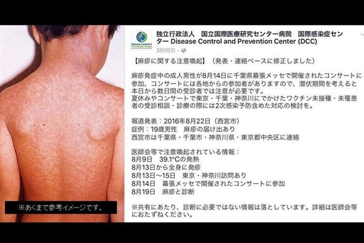 感染力の強い"はしか"が全国に拡がるおそれ…特に妊婦等 厚労省が注意喚起中!